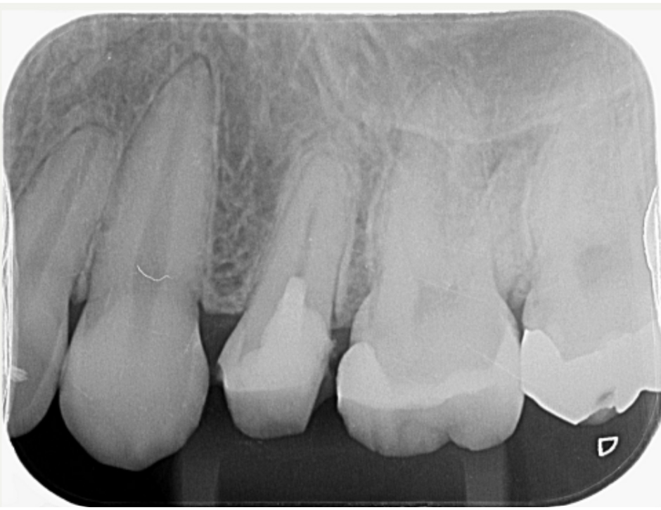 MTA覆髄法による治療後のレントゲン画像