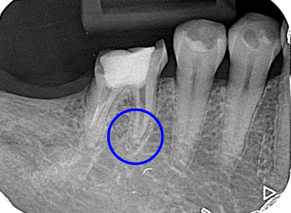 破折ファイル除去後の術後レントゲン画像